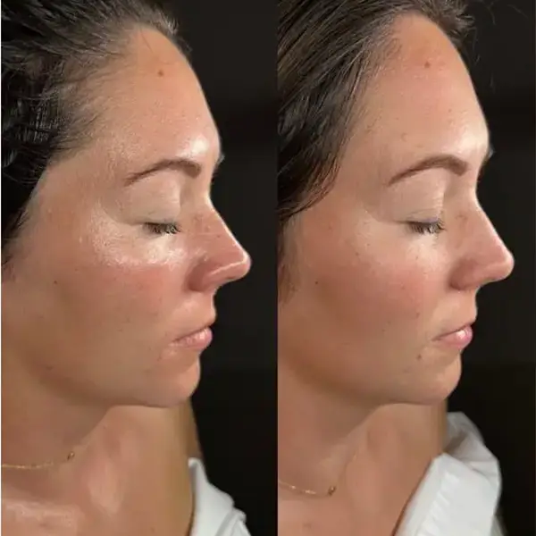 Diamond peel - Puntas de Diamante