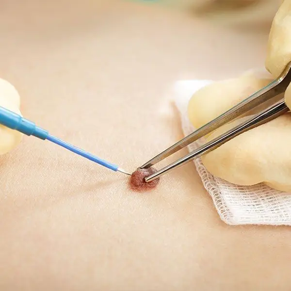 Eliminación de verrugas y acrocodones